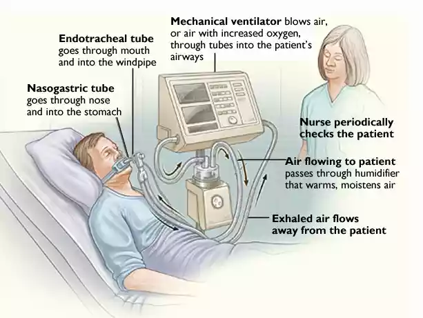 Mechanical Ventilation