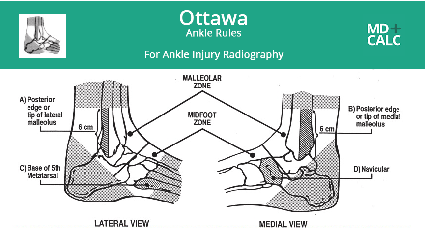 Ottawa ankle rules